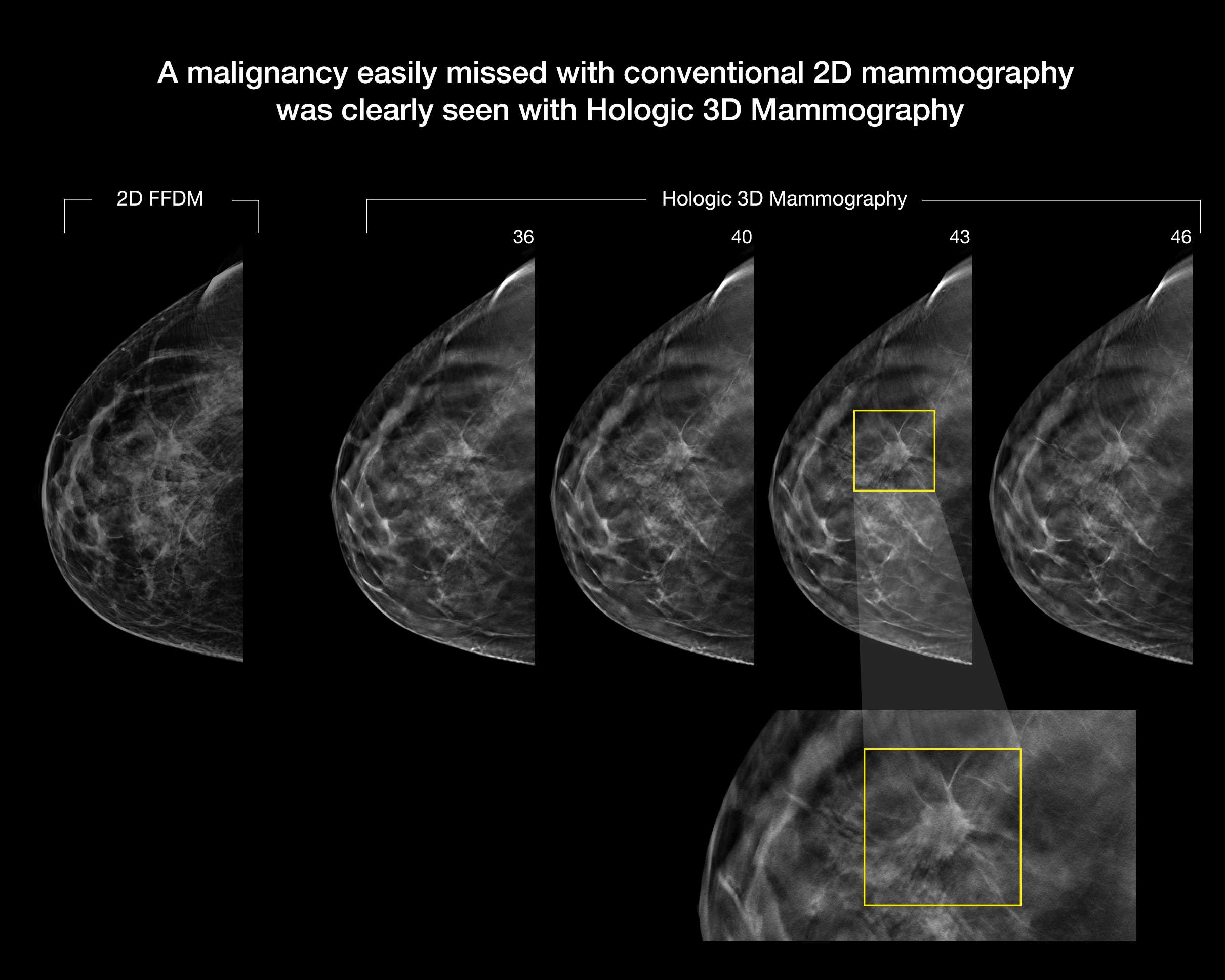 Selenia Dimensions 3d Mammography Hologic 8774